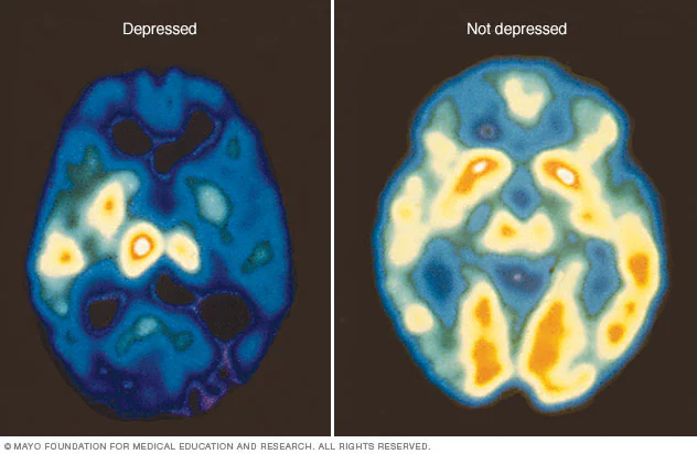 Brain scan comparison showing depressed vs non-depressed brain activity