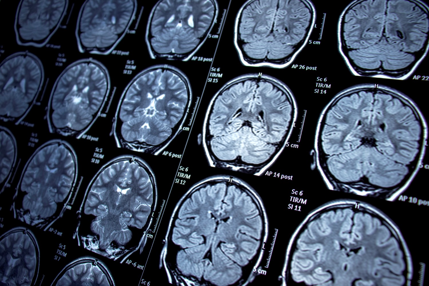Brain scan showing neural activity patterns
